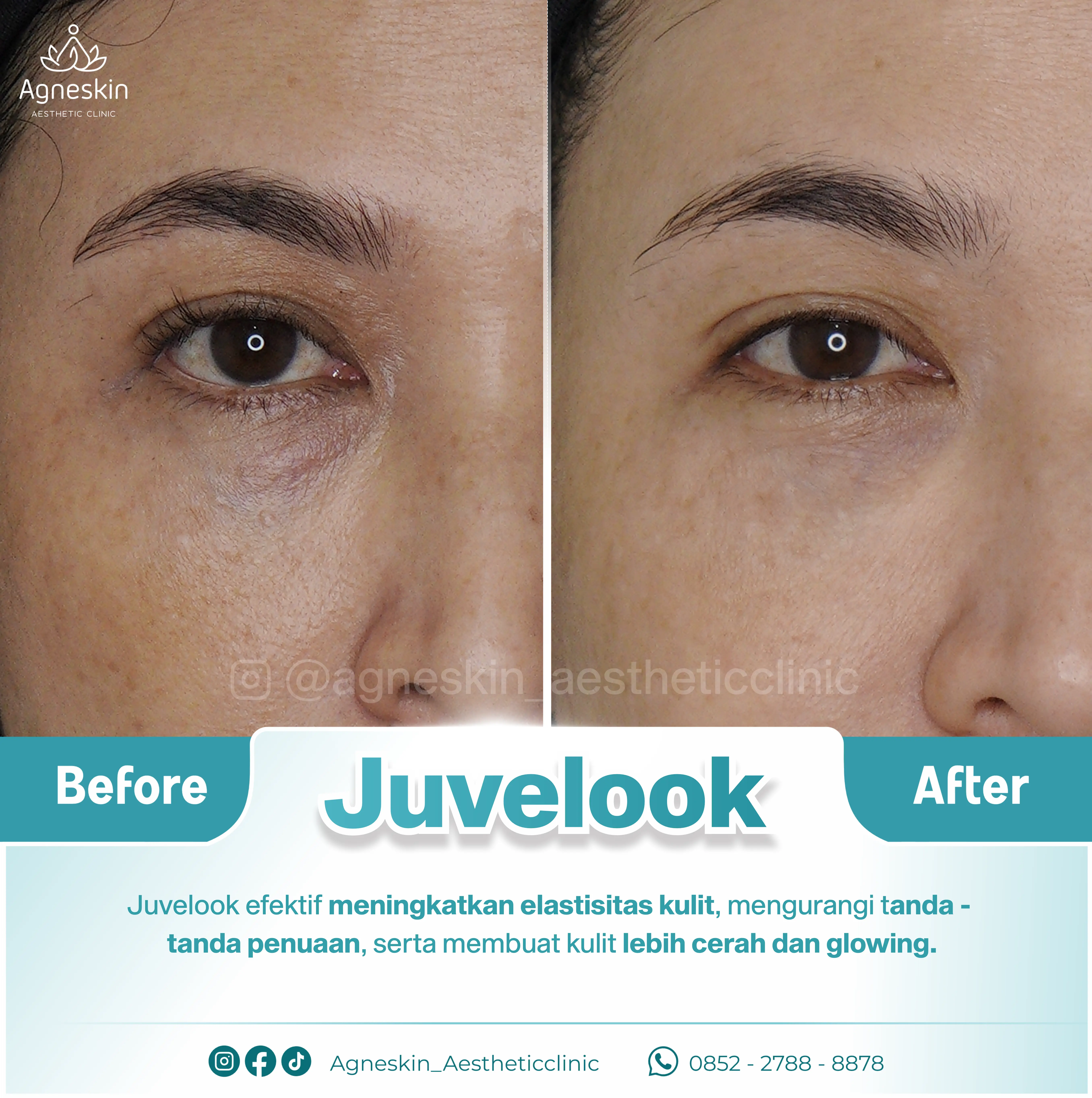 Before After Juvelook